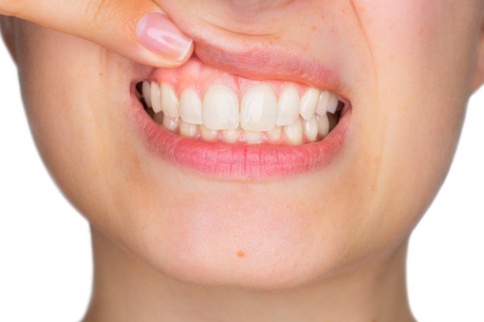Problem krwawiących dziąseł – jak utrzymać dobrą kondycję zębów i dziąseł
